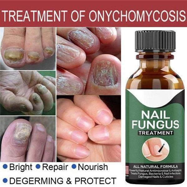 Hypoallergenic Nail Fungus Treatment Serum - 1 Pc for Effective Health