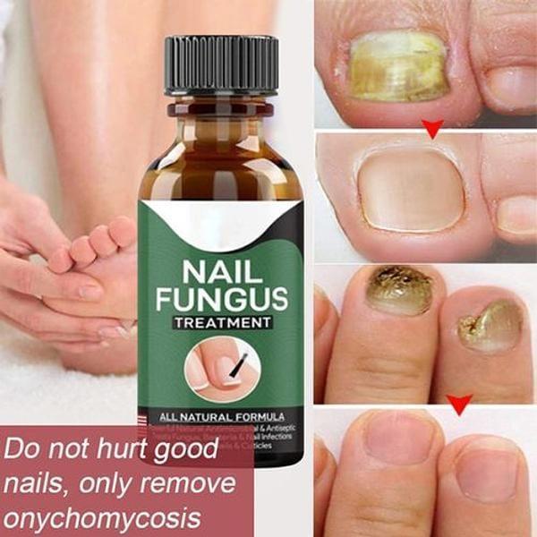 Hypoallergenic Nail Fungus Treatment Serum - 1 Pc for Effective Health