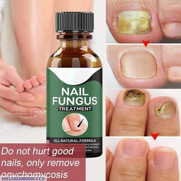 Hypoallergenic Nail Fungus Treatment Serum - 1 Pc for Effective Health